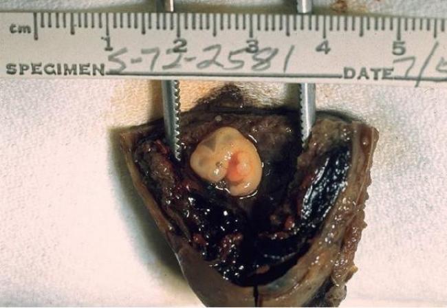 feto/https://commons.wikimedia.org/wiki/File:Tubal_pregnancy,_gross_pathology_01ee049_lores.jpg